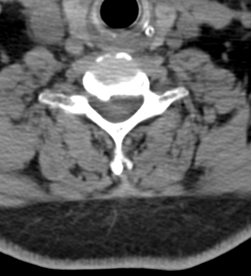 Cervical canal stenosis due to ossification of the posterior longitudinal ligament (Radiopaedia 47260-51823 Axial non-contrast 45).png