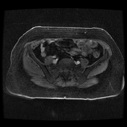 Cervical carcinoma (Radiopaedia 70924-81132 Axial T1 C+ fat sat 251).jpg