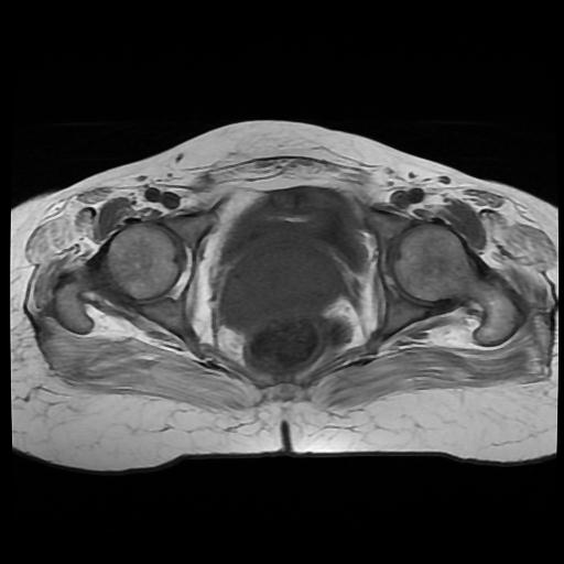 File:Cervical carcinoma (Radiopaedia 88010-104555 Axial T1 15).jpg