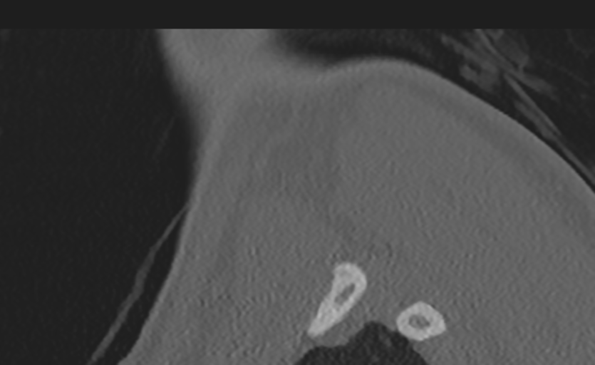 Cervical disc replacement (Radiopaedia 37383-39205 Sagittal bone window 76).png