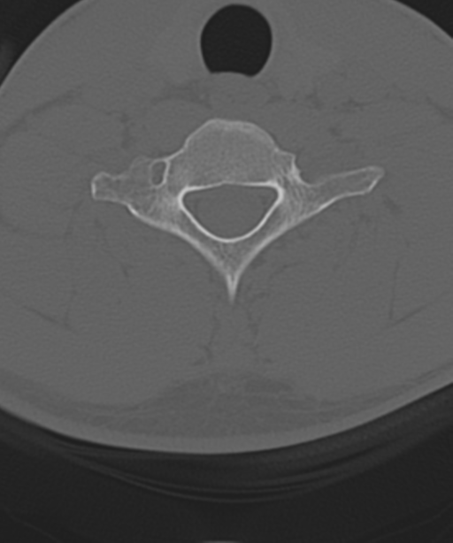 Cervical intercalary bone (Radiopaedia 35211-36748 Axial bone window 50).png