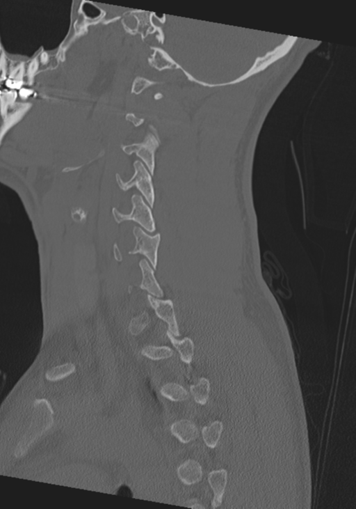 Cervical intercalary bone (Radiopaedia 35211-36748 Sagittal bone window 25).png