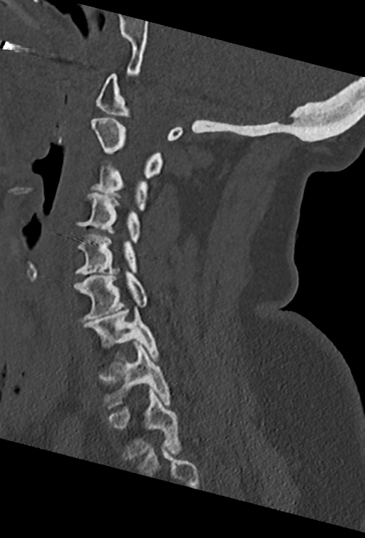 Cervical spine ACDF loosening (Radiopaedia 48998-54070 Sagittal bone window 37).png