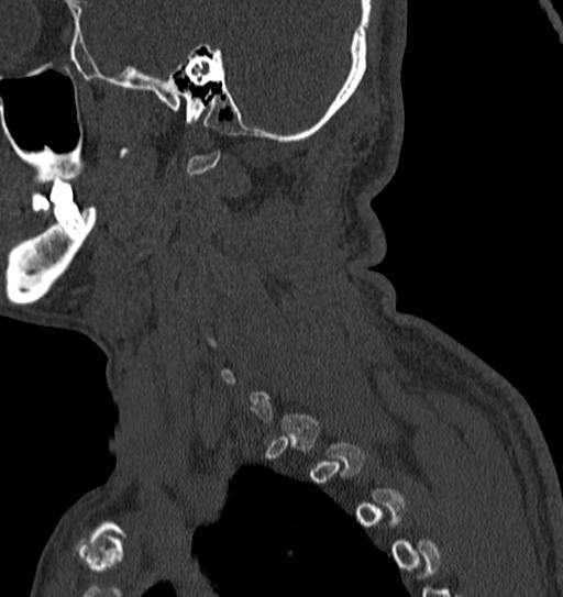 File:Cervical spine trauma with tear drop fracture and perched facet joint (Radiopaedia 53989-60127 Sagittal bone window 3).jpg