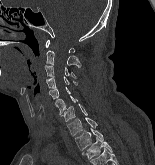 Cervical spine trauma with tear drop fracture and perched facet joint (Radiopaedia 53989-60127 Sagittal bone window 99).jpg