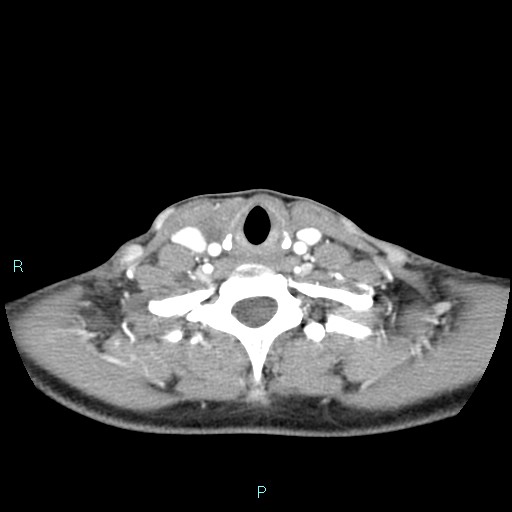 File:Cervical thymic cyst (Radiopaedia 88632-105335 B 40).jpg