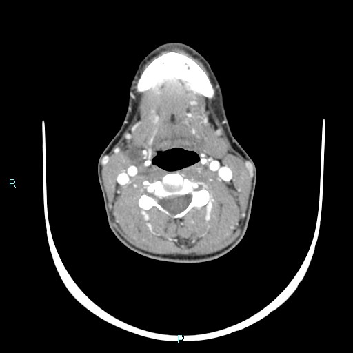 Cervical thymic cyst (Radiopaedia 88632-105335 B 65).jpg