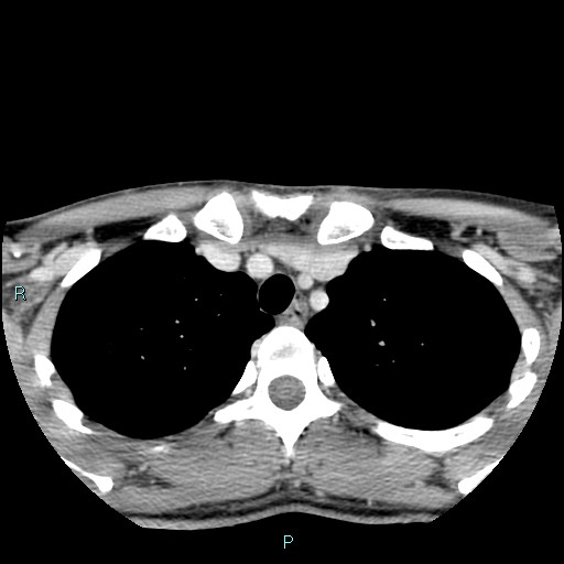 Cervical thymic cyst (Radiopaedia 88632-105335 C 14).jpg