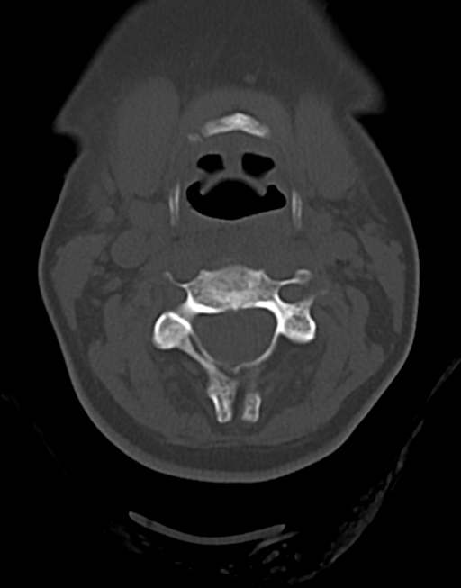 Cervical tuberculous spondylitis (Radiopaedia 39149-41365 Axial bone window 21).png