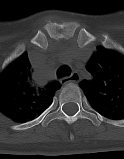 Cervical tuberculous spondylitis (Radiopaedia 39149-41365 Axial bone window 56).png