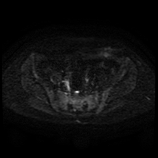 File:Cesarian section scar endometriosis (Radiopaedia 66520-75799 Axial DWI 56).jpg