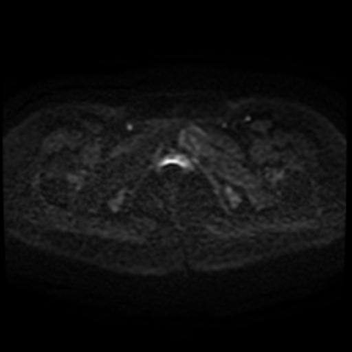Cesarian section scar endometriosis (Radiopaedia 66520-75799 Axial DWI 99).jpg
