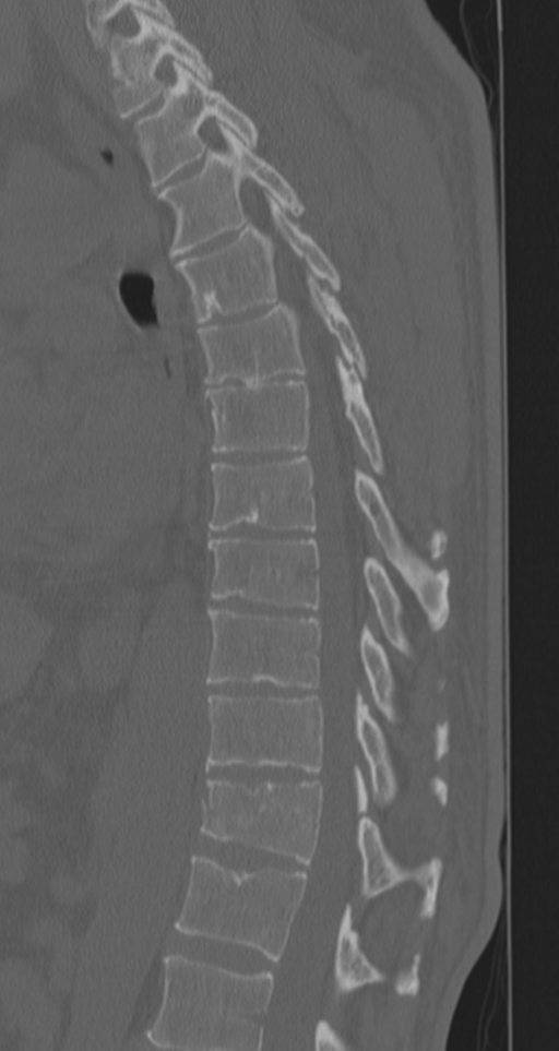 Chance fracture (Radiopaedia 33854-35020 Sagittal bone window 40).png