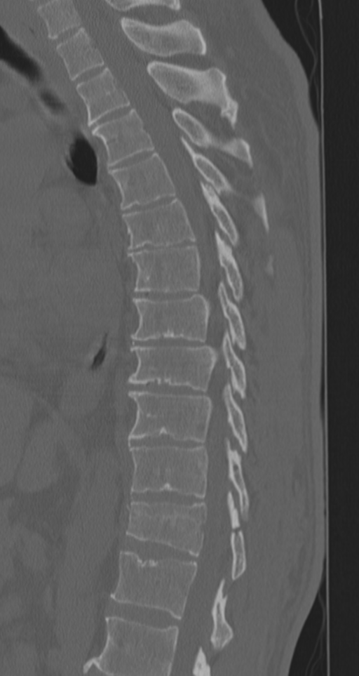 Chance fracture (Radiopaedia 33854-35020 Sagittal bone window 47).png