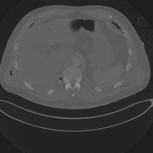 Chest multitrauma - aortic injury (Radiopaedia 34708-36147 Axial bone window 281).png