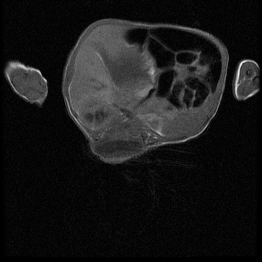 File:Chiari II malformation with spinal meningomyelocele (Radiopaedia 23550-23652 Axial T1 10).jpg