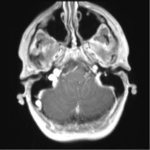 File:Chiari I malformation and obstructive hydrocephalus (Radiopaedia 41185-43978 Axial T1 C+ 8).png
