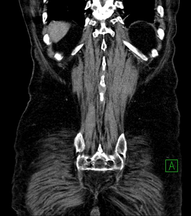 Cholangiocarcinoma with cerebral metastases (Radiopaedia 83519-98629 E 76).jpg