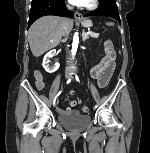 File:Cholecystoduodenal fistula due to calculous cholecystitis with gallstone migration (Radiopaedia 86875-103077 B 25).jpg