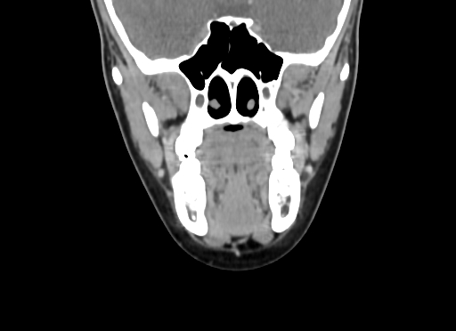 Chondroblastic osteosarcoma (Radiopaedia 67363-76741 D 47).jpg