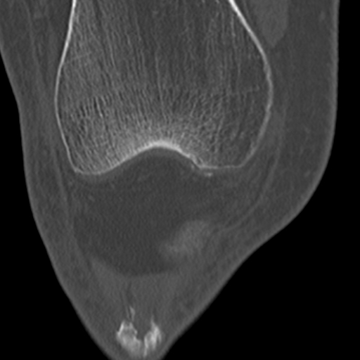 Chondrocalcinosis (Radiopaedia 16275-15955 Coronal bone window 19).jpg