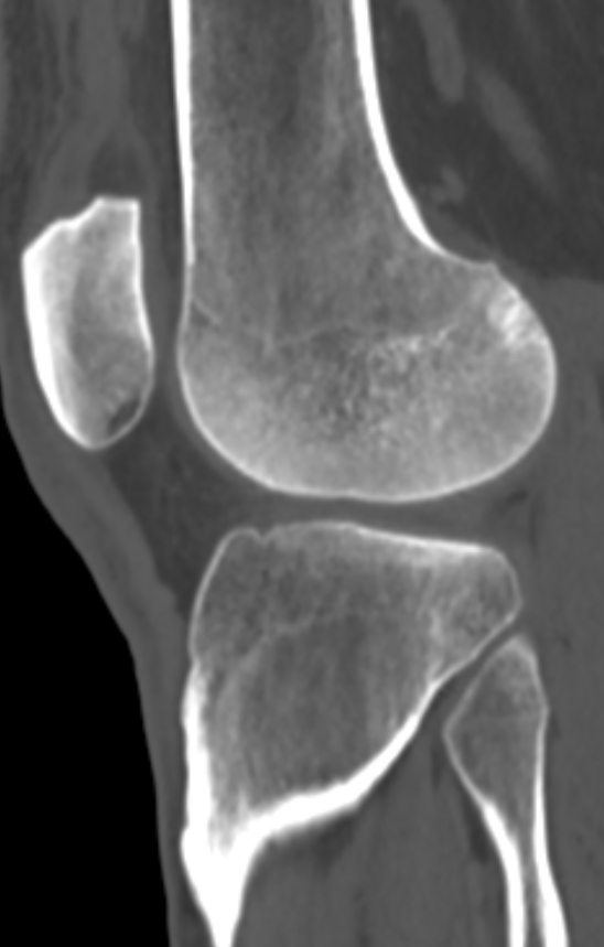 Chondrocalcinosis (Radiopaedia 82862-97173 Sagittal bone window 45).jpg