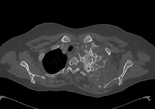 Chondrosarcoma - chest wall (Radiopaedia 65192-74199 Axial bone window 23).jpg