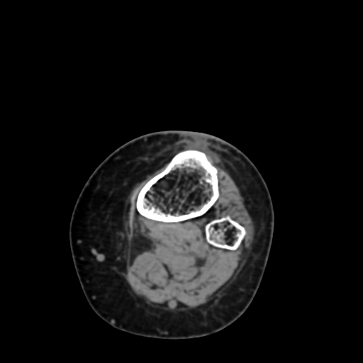 Chondrosarcoma - femur (Radiopaedia 64187-72954 Axial non-contrast 76).jpg