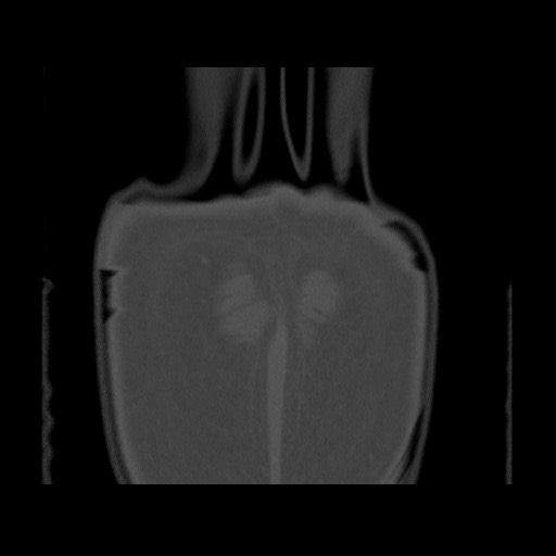Chondrosarcoma of iliac wing (Radiopaedia 63861-72599 Coronal bone window 112).jpg