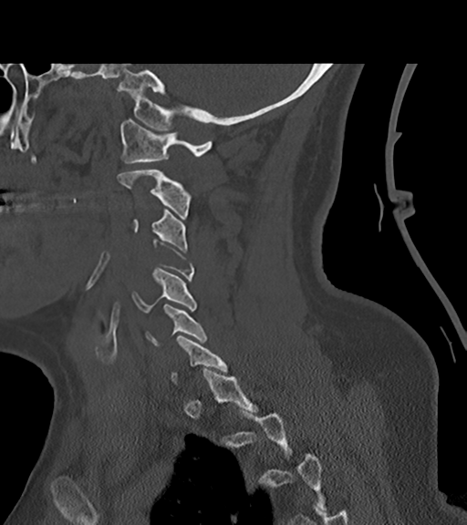 File:Chordoma (C4 vertebra) (Radiopaedia 47561-52188 Sagittal bone window 52).png