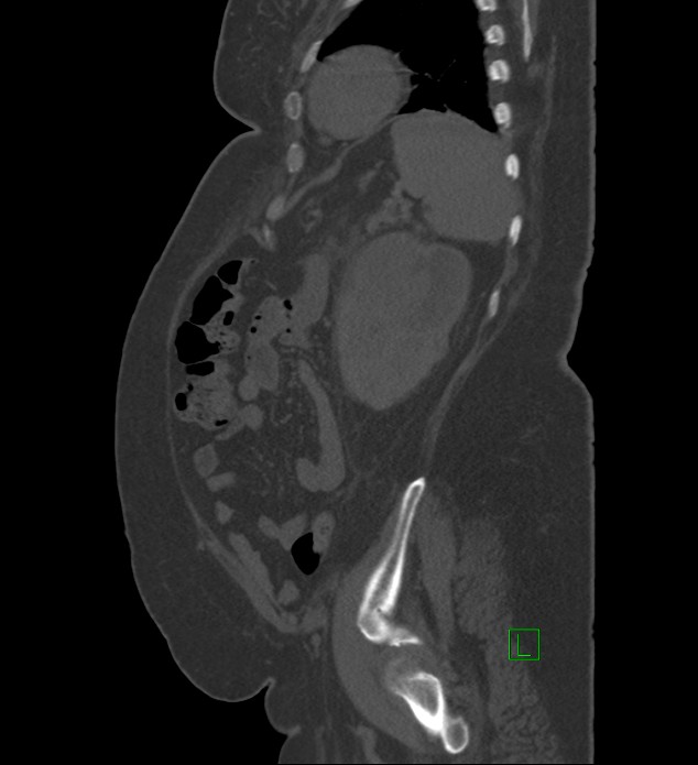 Chromophobe renal cell carcinoma (Radiopaedia 84239-99519 Sagittal bone window 22).jpg
