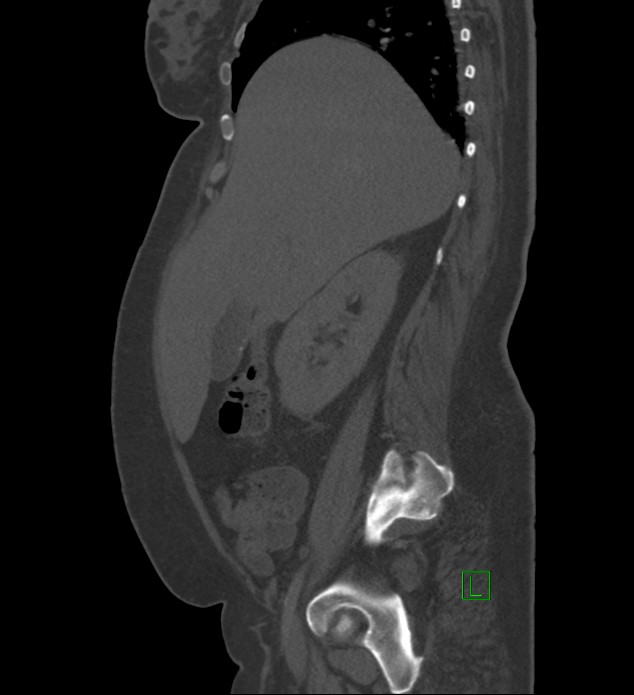 Chromophobe renal cell carcinoma (Radiopaedia 84239-99519 Sagittal bone window 76).jpg