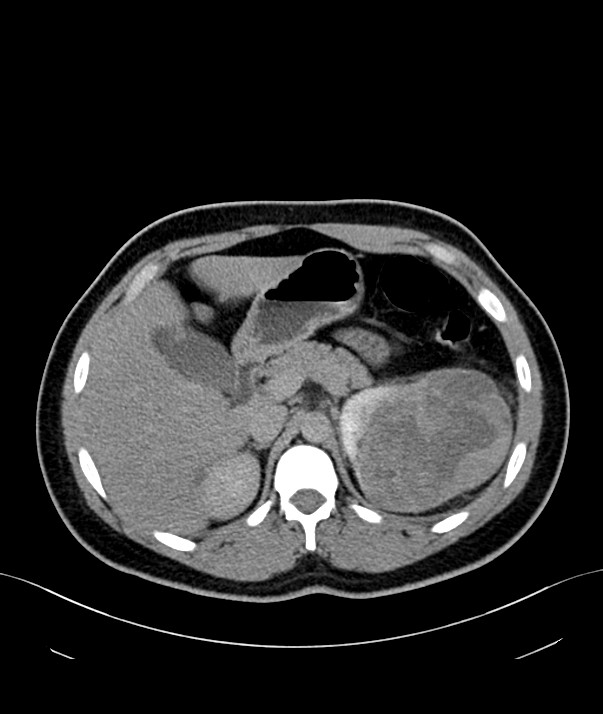 Chromophobe renal cell carcinoma (Radiopaedia 84255-99542 H 7).jpg