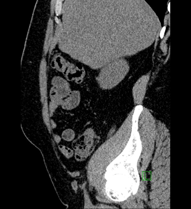 Chromophobe renal cell carcinoma (Radiopaedia 84286-99573 C 143).jpg