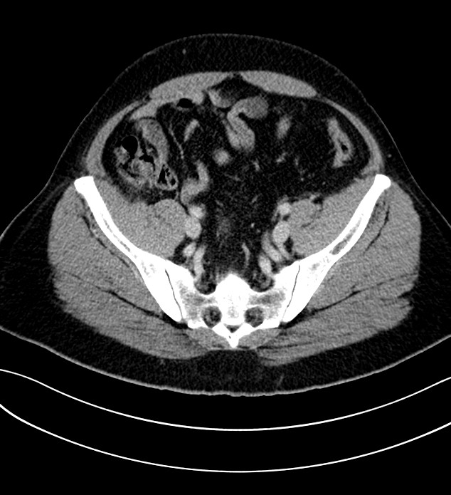 Chromophobe renal cell carcinoma (Radiopaedia 84286-99573 G 57).jpg