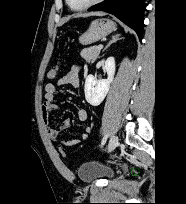 Chromophobe renal cell carcinoma (Radiopaedia 84286-99573 I 64).jpg