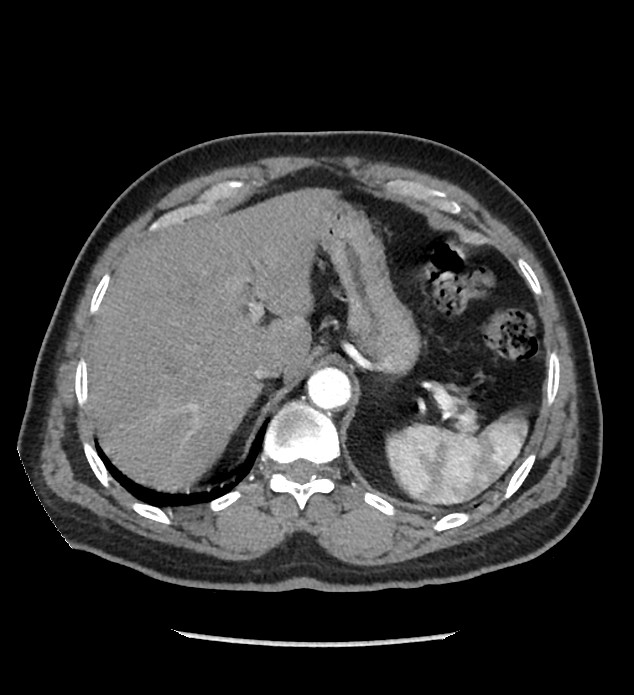 Chromophobe renal cell carcinoma (Radiopaedia 86879-103083 B 32).jpg