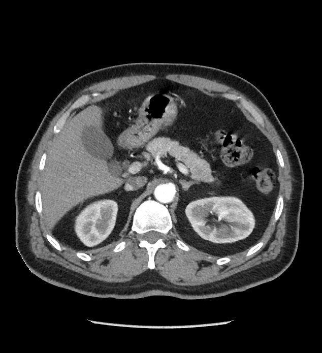 Chromophobe renal cell carcinoma (Radiopaedia 86879-103083 B 43).jpg