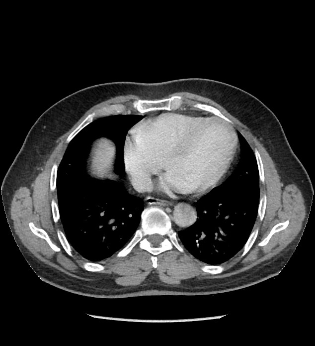 Chromophobe renal cell carcinoma (Radiopaedia 86879-103083 C 1).jpg