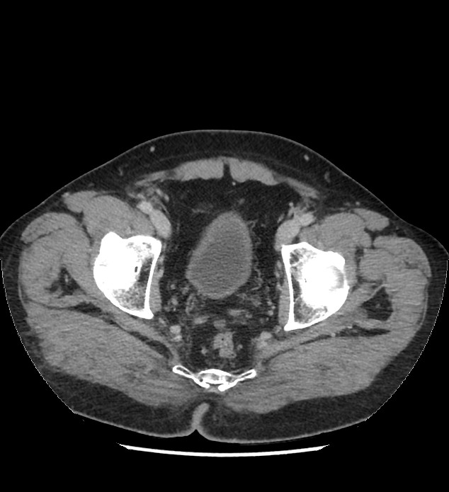 Chromophobe renal cell carcinoma (Radiopaedia 86879-103083 C 139).jpg
