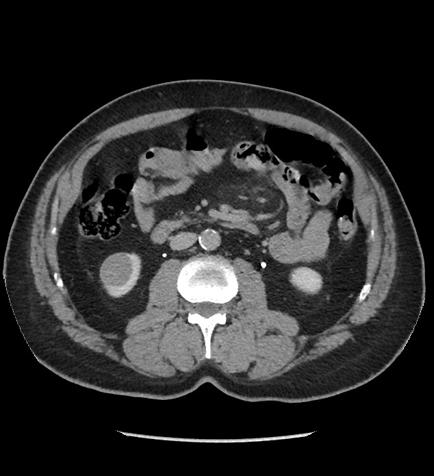 Chromophobe renal cell carcinoma (Radiopaedia 86879-103083 D 69).jpg