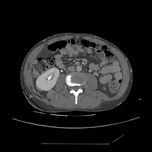 File:Chronic IVC thrombosis and resultant IVC filter malposition (Radiopaedia 81158-94800 A 113).jpg