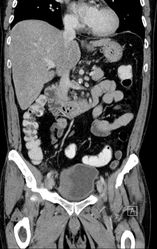 Chronic appendicitis complicated by appendicular abscess, pylephlebitis and liver abscess (Radiopaedia 54483-60700 C 37).jpg