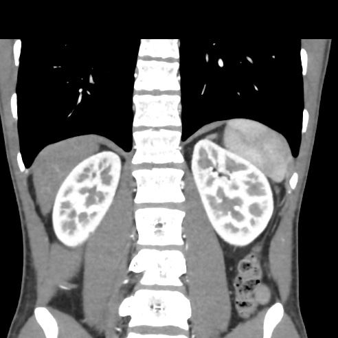 File:Chronic calcific pancreatitis (Radiopaedia 56280-62953 E 26).jpg