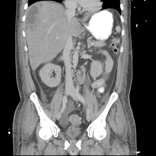 Chronic diverticulitis complicated by hepatic abscess and portal vein thrombosis (Radiopaedia 30301-30938 B 32).jpg