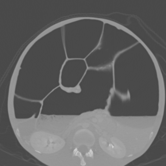 Chronic large bowel pseudo-obstruction (Radiopaedia 43181-46492 Axial bone window 84).jpg