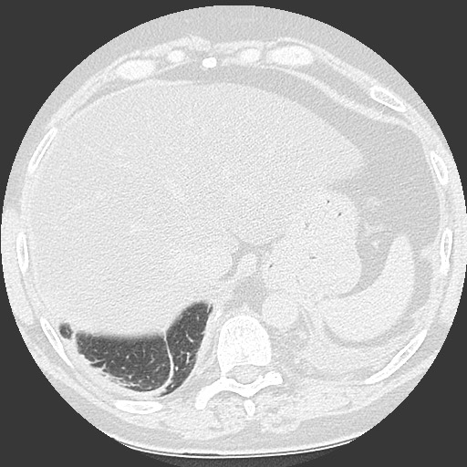 File:Chronic lung allograft dysfunction - restrictive form (Radiopaedia 60595-68316 Axial lung window 64).jpg