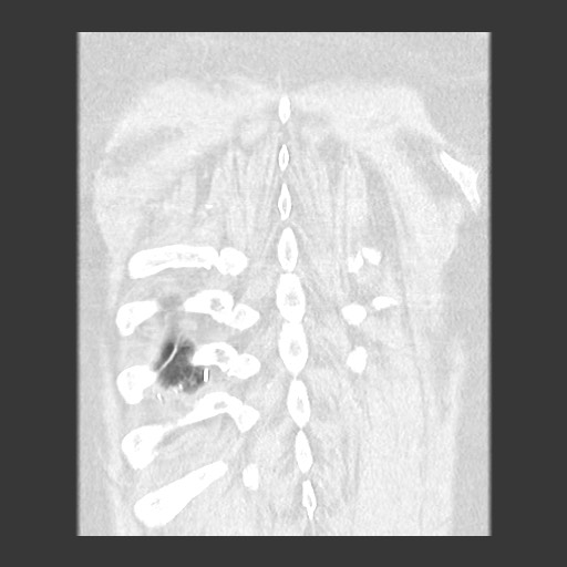 Chronic lung allograft dysfunction - restrictive form (Radiopaedia 60595-68316 Coronal lung window 86).jpg