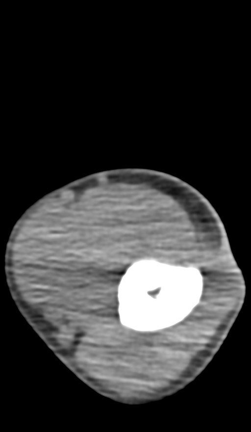 Chronic osteomyelitis of the distal humerus (Radiopaedia 78351-90971 Axial non-contrast 68).jpg