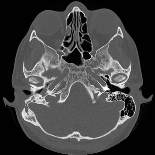 File:Chronic otomastoiditis (Radiopaedia 27138-27309 Axial bone window 24).jpg